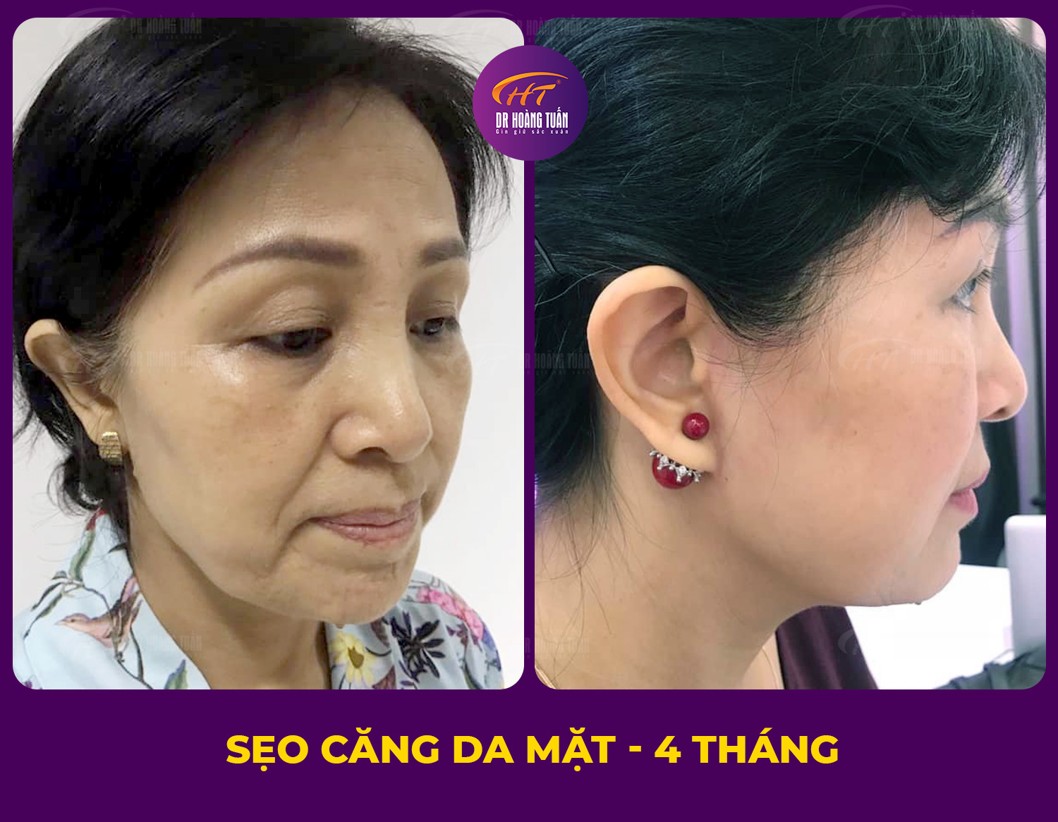 Hình ảnh sẹo căng da mặt - Dr Hoàng Tuấn